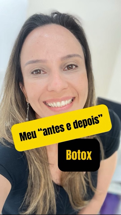 Reel da Dra. Fernanda: 15 dias de botox no próprio rosto