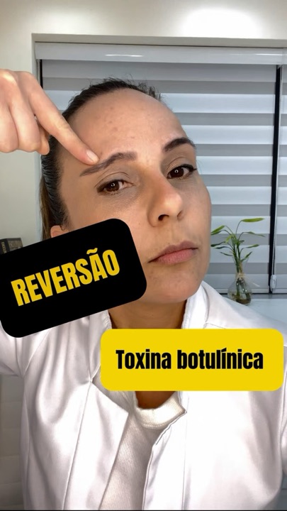Reel da Dra. Fernanda: sobrancelha caída depois do botox
